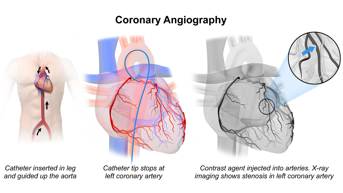 آنژیوگرافی قلب